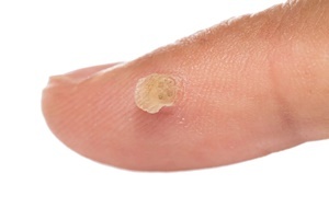 Bradavice je kožné ochorenie, ktoré účinne bojuje Skincell Pro