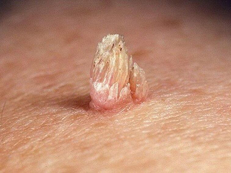 genitálny papilóm na tele