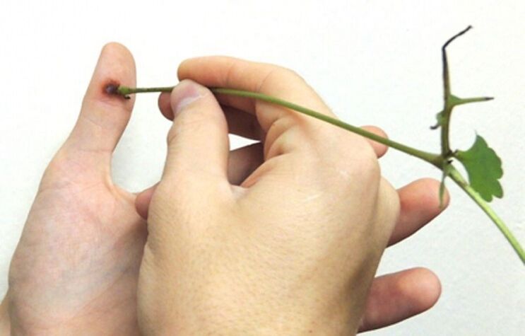 odstránenie bradavice na prste celandínovou bylinkovou šťavou