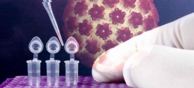 Diagnostika HPV pomocou testu digene